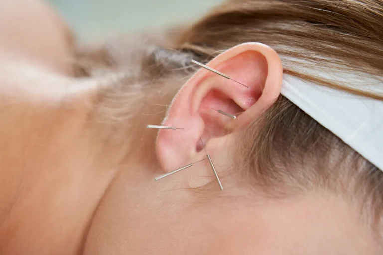 Acupunctura în Sindromul Meniere